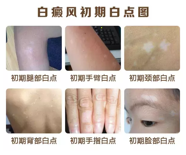 白癜风健康网